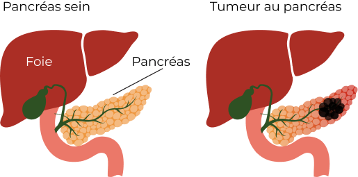 stades du cancer du pancréas
