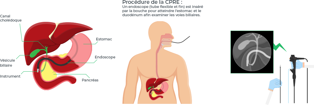 Illustration détaillée de la procédure ERCP