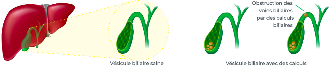 Illustration détaillée des calculs biliaires