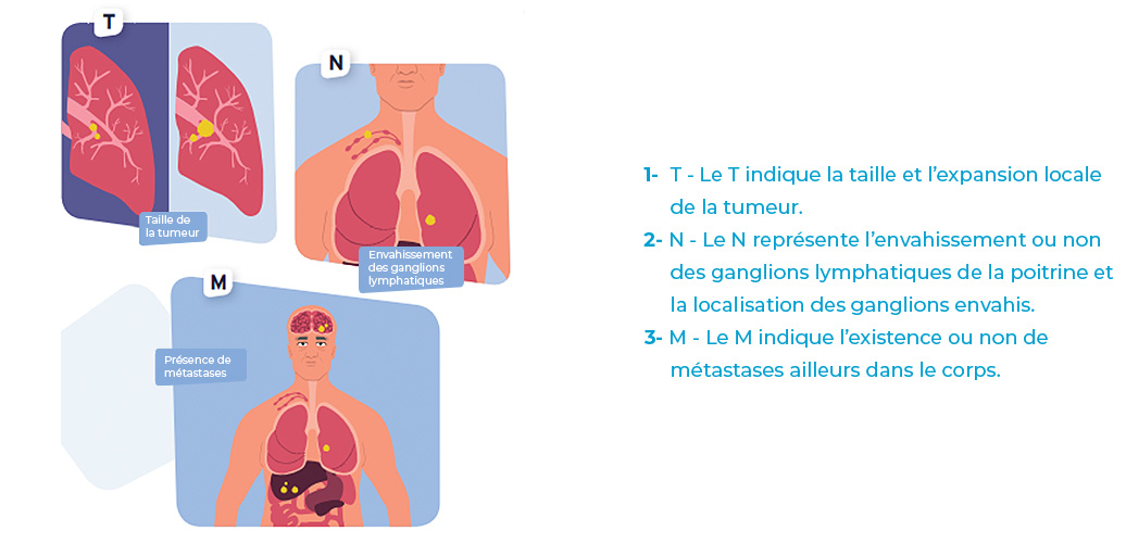 Type de cancer du poumon
