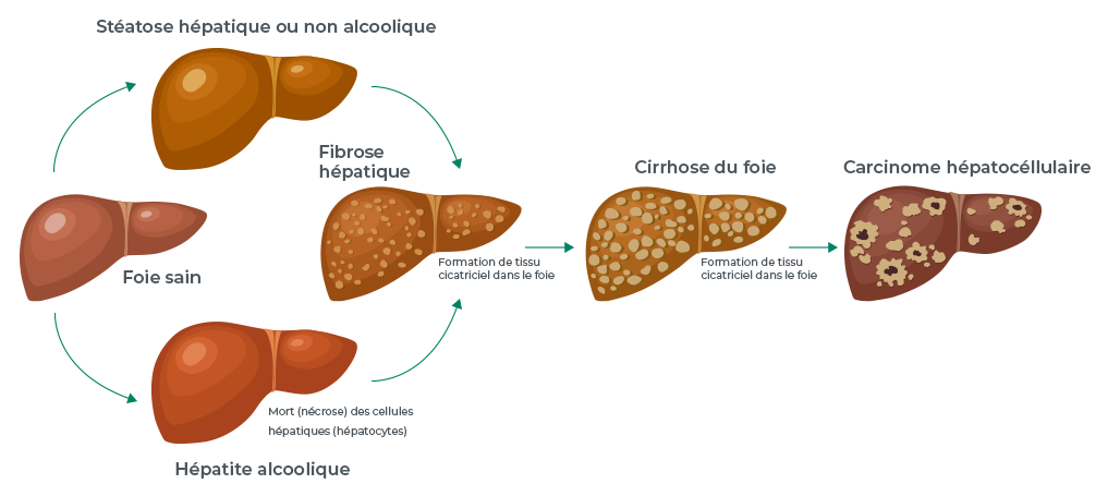 stéatose hépatique simple ou stéatose non alcoolique