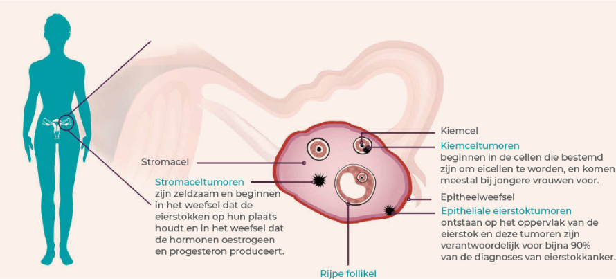 Ovarium Tumor Classificatie Diagram