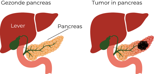 Pancreaskanker stadia