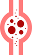 Embolisatie