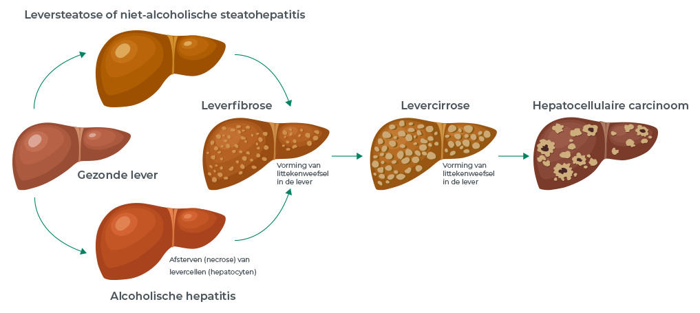 leversteatose of niet-alcoholische steatohepatitis