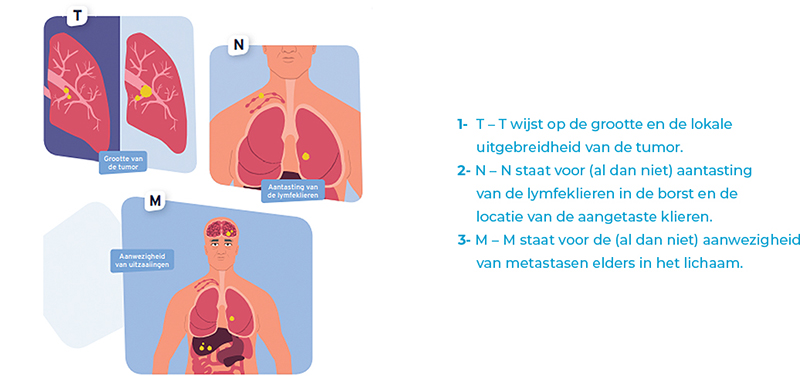 Soort longkanker